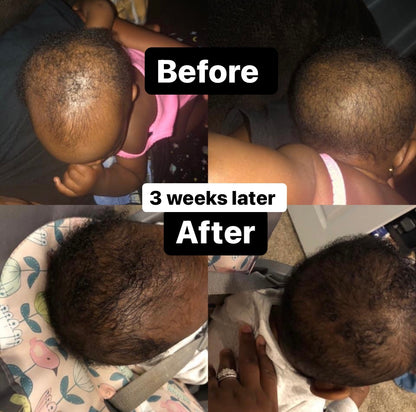 BABY ORGANIC Hair Growth Oil-Growth Boosting Hair Oil(cradle cap, scalp Eczema).